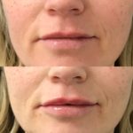 woman's lips before and after lip filler treatment showing improved lip volume and shape