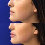 side profile of woman's lips before and after lip fillers showing improved lip volume and shape