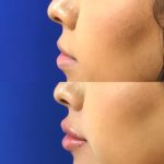 Before and after woman's injection of dermal fillers to enhance lips