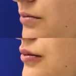 Before and after woman's injection of dermal fillers to enhance lips