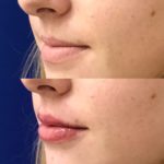 Before and after woman's injection of dermal fillers to enhance lips