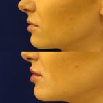side profile of woman's lips photos of lip filler treatment showing improved lip volume and shape
