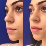 woman's lips before and after lip filler treatment showing improved lip shape and volume