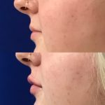 Before and after woman's injection of dermal fillers to enhance lips