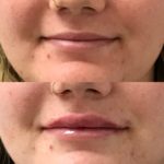 Before and after woman's injection of dermal fillers to enhance lips