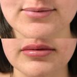 Before and after woman's injection of dermal fillers to enhance lips