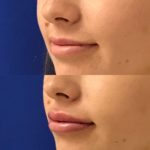 Before and after woman's injection of dermal fillers to enhance lips