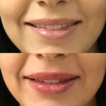 Before and after woman's injection of dermal fillers to enhance lips