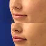 Before and after woman's injection of dermal fillers to enhance lips