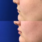 Before and after woman's injection of dermal fillers to enhance lips