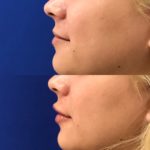 Before and after woman's injection of dermal fillers to enhance lips