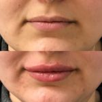 Before and after woman's injection of dermal fillers to enhance lips