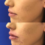 woman's lips before and after lip filler treatment to improve lip shape and volume