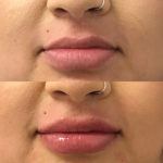 woman's lips before and after lip filler treatment to improve lip shape and volume