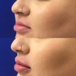 woman's lips before and after lip filler treatment to improve lip shape and volume