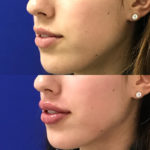 Before and after woman's injection of dermal fillers to enhance lips