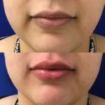 Before and after woman's injection of dermal fillers to enhance lips