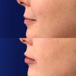 Before and after woman's injection of dermal fillers to enhance lips