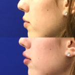 Before and after woman's injection of dermal fillers to enhance lips