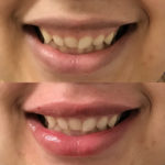 Before and after woman's injection of dermal fillers to enhance lips