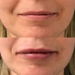 Before and after woman's injection of dermal fillers to enhance lips