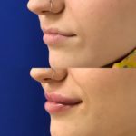 Before and after woman's injection of dermal fillers to enhance lips