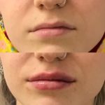 Before and after woman's injection of dermal fillers to enhance lips