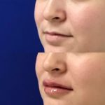 Before and after woman's injection of Juvederm to enhance lips