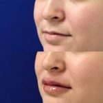 Before and after woman's injection of Juvederm to enhance lips