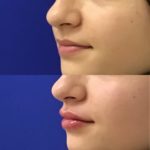 Before and after woman's injection of Juvederm to enhance lips