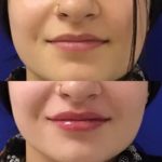 Before and after woman's injection of Juvederm to enhance lips