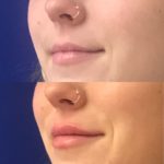 Before and after woman's injection of Juvederm to enhance lips