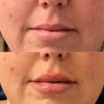 Before and after woman's injection of Juvederm to enhance lips