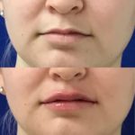 Before and after woman's injection of Juvederm to enhance lips