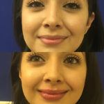 Before and after woman's injection of dermal fillers to enhance lips