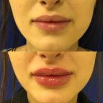 Before and after woman's injection of dermal fillers to enhance lips