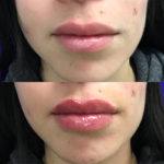 Before and after woman's injection of dermal fillers to enhance lips