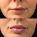 Before and after woman's injection of dermal fillers to enhance lips