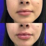 Before and after woman's injection of dermal fillers to enhance lips