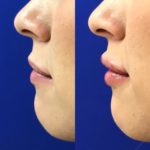 Before and after woman's injection of dermal fillers to enhance lips