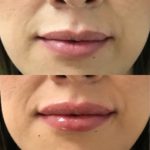 Before and after woman's injection of dermal fillers to enhance lips