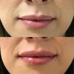 Before and after woman's injection of dermal fillers to enhance lips