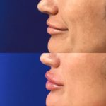 Before and after woman's injection of dermal fillers to enhance lips