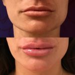 Before and after woman's injection of dermal fillers to enhance lips