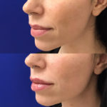 Before and after woman's injection of dermal fillers to enhance lips