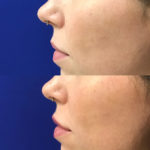 Before and after woman's injection of dermal fillers to enhance lips