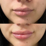 Before and after woman's injection of dermal fillers to enhance lips