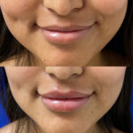 Before and after woman's injection of dermal fillers to enhance lips