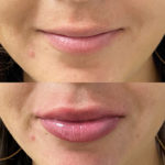 Before and after woman's injection of dermal fillers to enhance lips