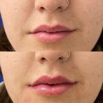 Before and after woman's injection of dermal fillers to enhance lips